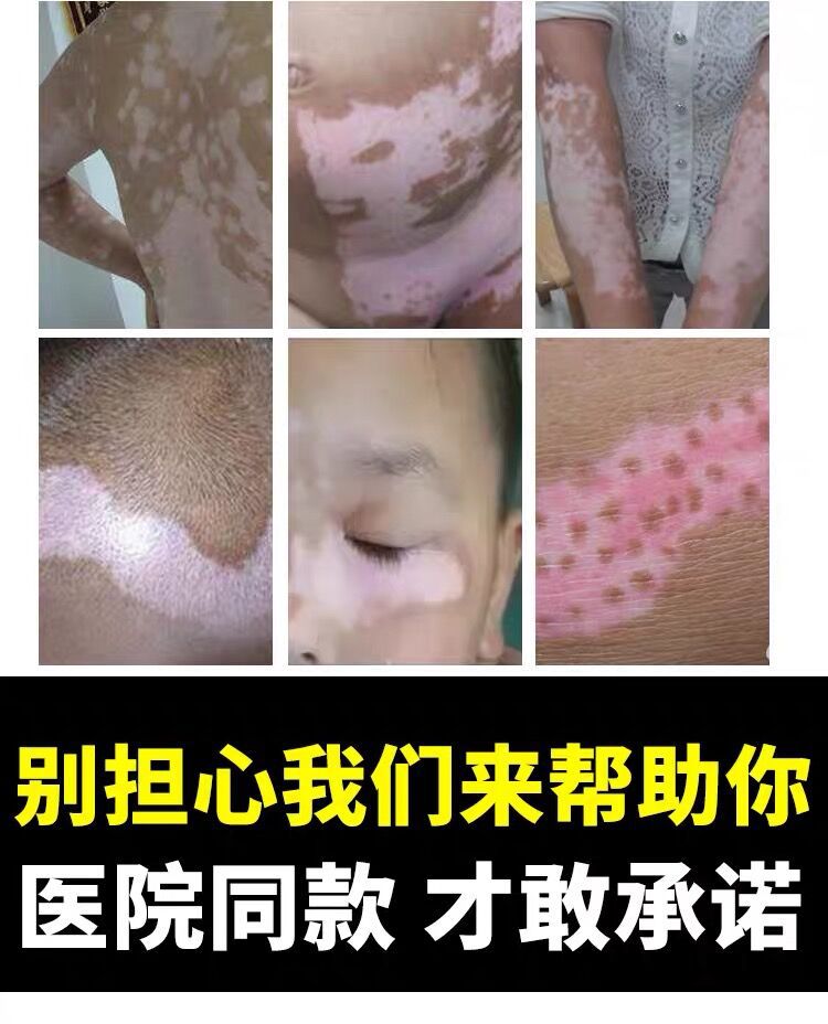 白癜风光疗仪银屑病治疗仪uvb311白斑紫外线治疗灯仪器中药理疗