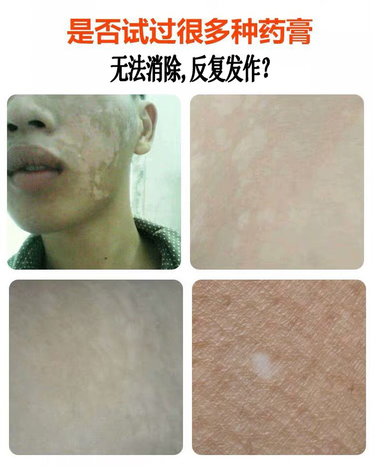 白癜风光疗仪银屑病治疗仪uvb311白斑紫外线治疗灯仪器中药理疗