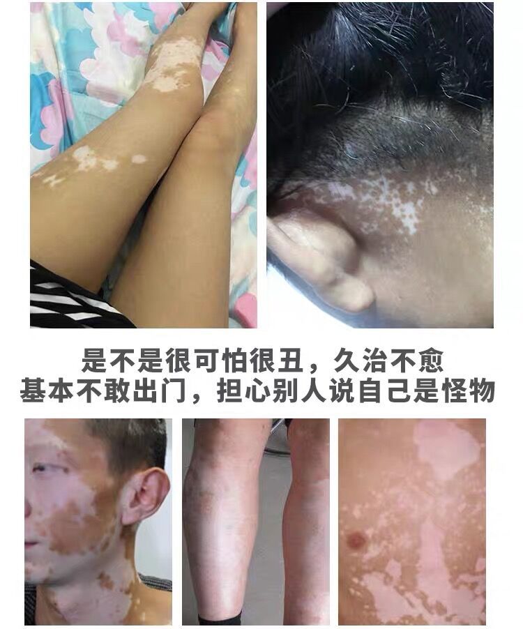 白癜风光疗仪银屑病治疗仪uvb311白斑紫外线治疗灯仪器中药理疗