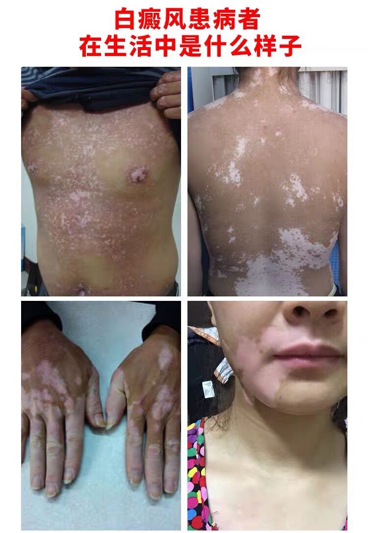 白癜风光疗仪银屑病治疗仪uvb311白斑紫外线治疗灯仪器中药理疗